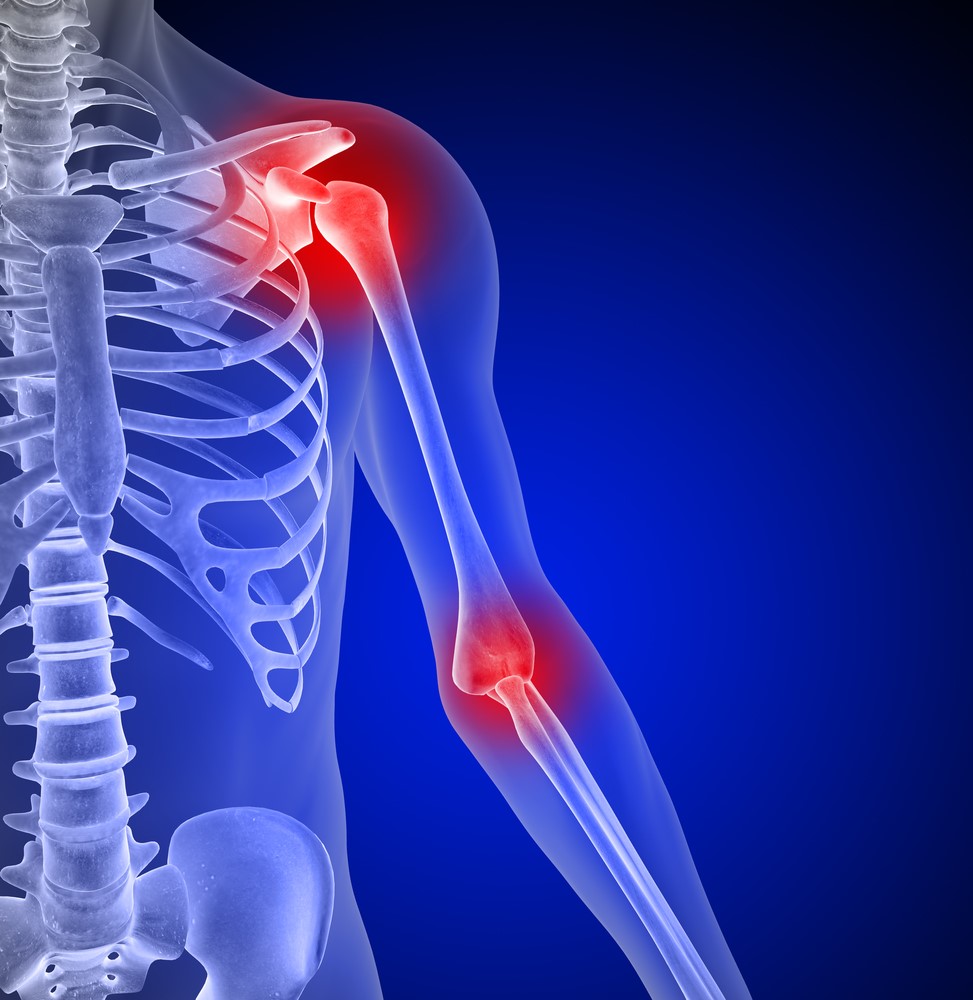 arthralgia