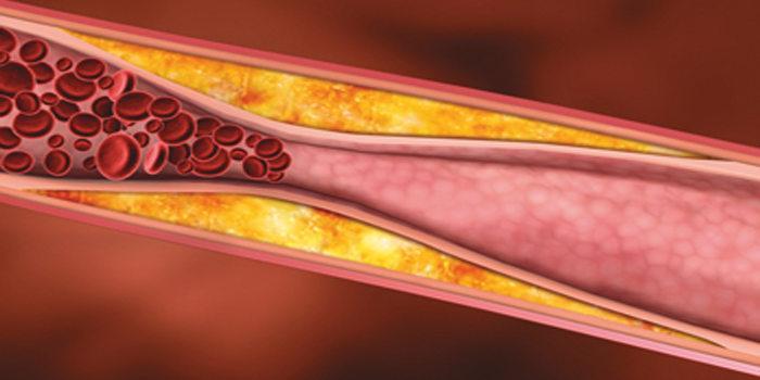 ΑΘΗΡΩΜΑΤΩΣΗ