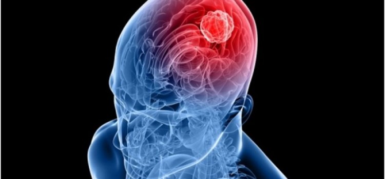 ΚΕΤΩΣΗ ΚΑΙ ΚΑΡΚΙΝΟΣ