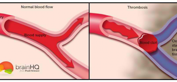 ΑΡΩΜΑΤΟΠΟΙΗΣΗ  ΚΑΙ  ΘΡΟΜΒΩΣΗ