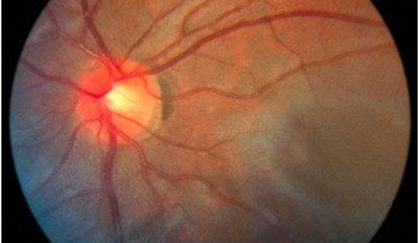 ΑΝΑΣΤΟΛΕΙΣ  ΑΡΩΜΑΤΑΣΗΣ  ΚΑΙ  ΟΠΤΙΚΕΣ  ΔΙΑΤΑΡΑΧΕΣ