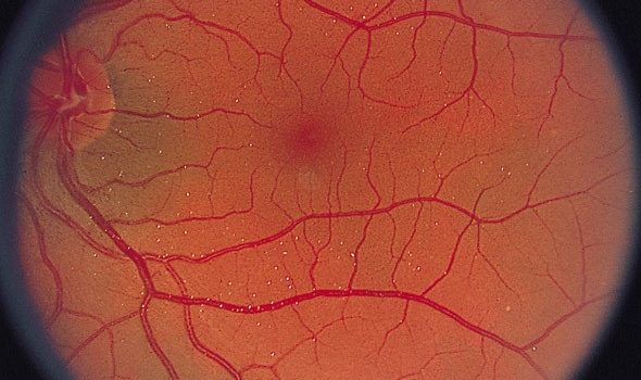 AROMATASE INHIBITORS AND VISUAL DISORDERS