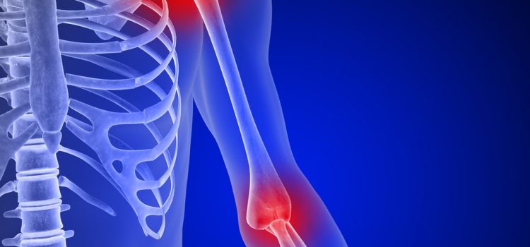 ARTHRALGIA OF AROMATASE INHIBITORS