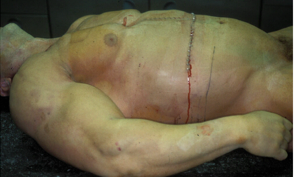 BODYBUILDING AND MORTALITY